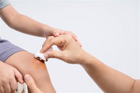 Home Remedy at Herbal na Gamot sa Sugat na may Nana.